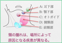 くびの腫れは場所によって原因となる疾患が異なる